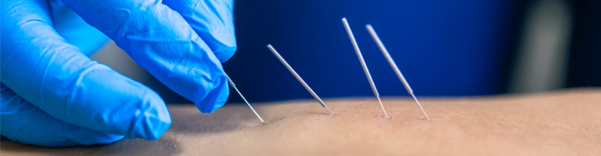 Dry Needling