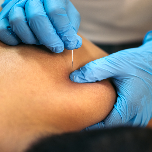 dry-needling-Trailhead-Physical-Therapy-and-Performance-Livingston-MT