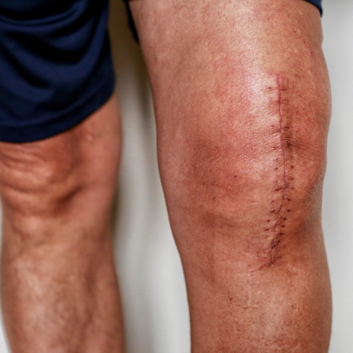 Trailhead-Physical-Therapy-and-Performance-Livingston-MT-joint-replacement-rehabilitation